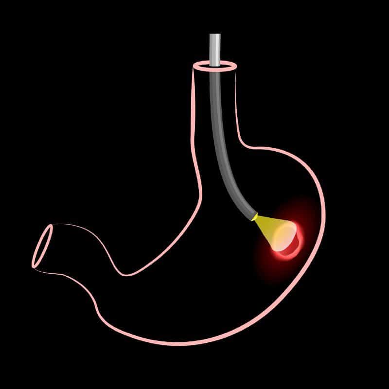 Flexible Endoscope in Stomach